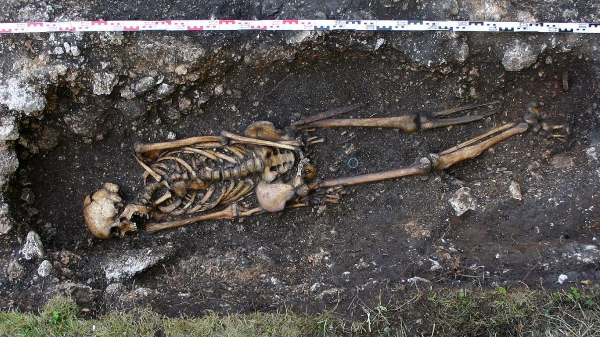 Skeleton missing left foot and ankle with prosthetic implant at Hemmaberg, Austria. (Austrian Archaeology Institute/Josef Eitler/AFP/Getty)