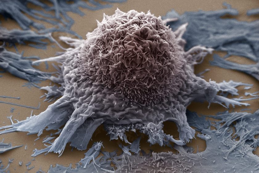 Lung cancer cell, SEM X3500. (Getty Images)
