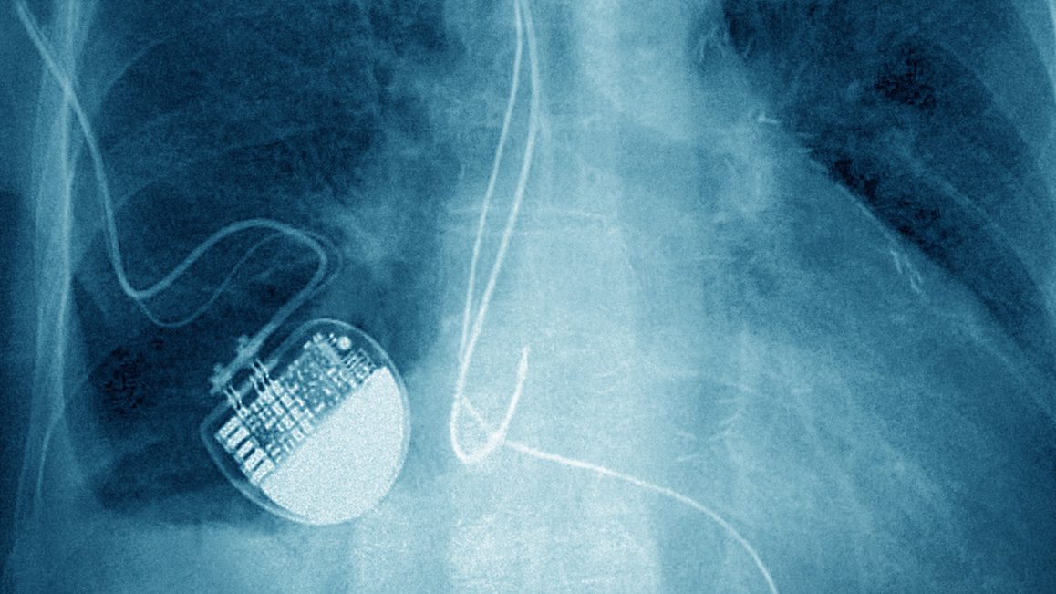 Implanted Pacemaker seen on a frontal chest x-ray. (Photo by: BSIP/UIG via Getty Images)