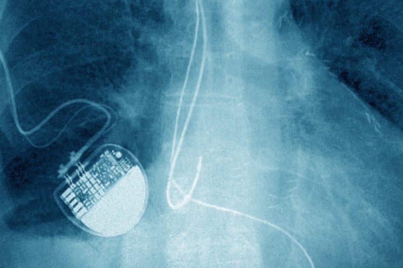 Implanted Pacemaker seen on a frontal chest x-ray. (Photo by: BSIP/UIG via Getty Images)