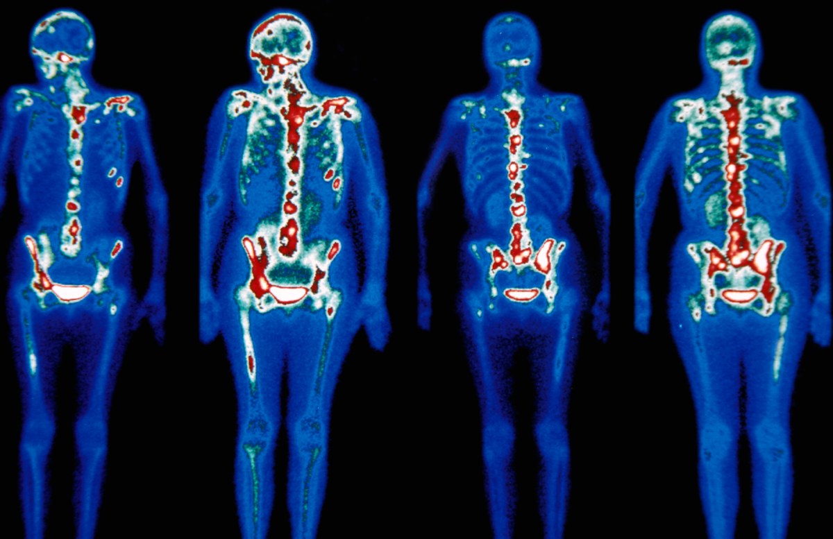 Scientists Discovered How Cancer Spreads And How To Slow It InsideHook scientists-discovered-how-cancer-spreads-and-how-to-slow-it-insidehook