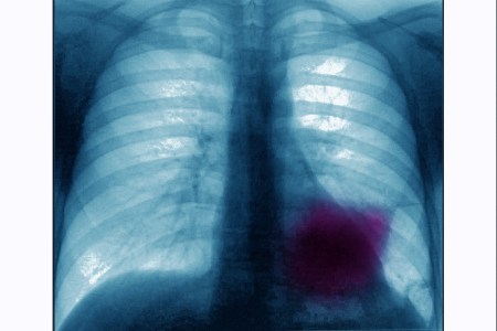 lung cancer