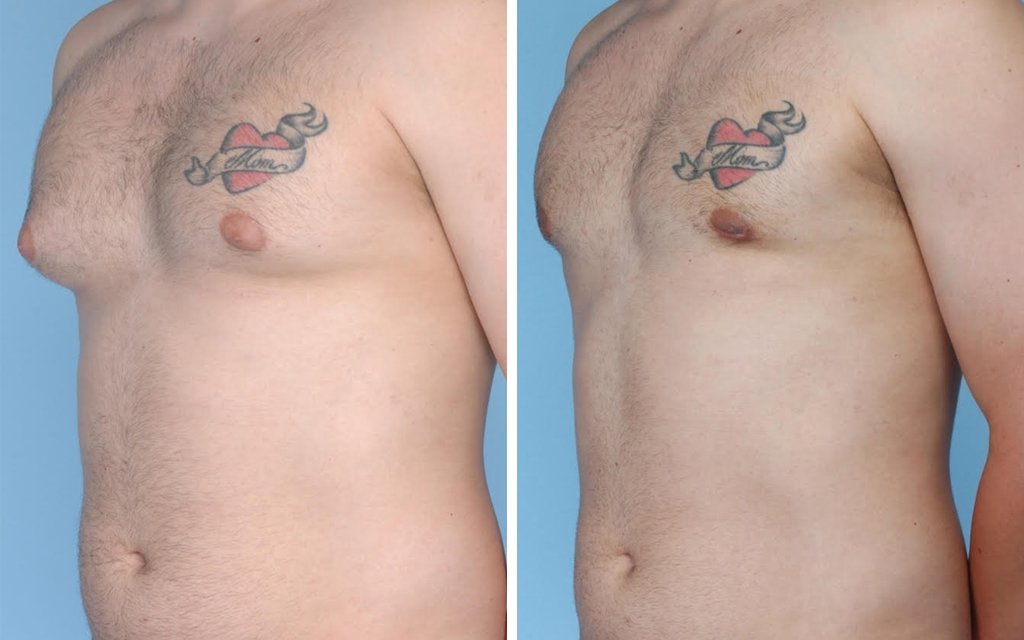 Gynecomastia: Symptoms, Causes, Complications, Risk Factors, Diagnosis and Treat
