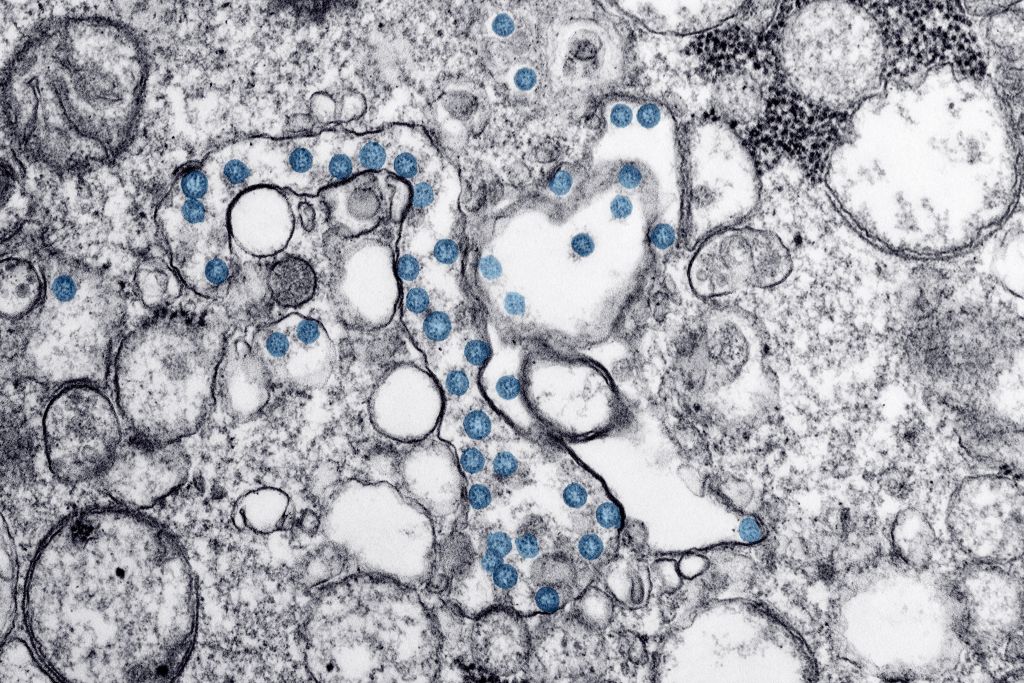 Transmission electron microscopic image of an isolate from the first US case of COVID-19, formerly known as 2019-nCoV, a coronavirus, March, 2020. The spherical viral particles, colorized blue, contain cross-sections through the viral genome, seen as black dots. (Photo by Smith Collection/Gado/Getty Images)