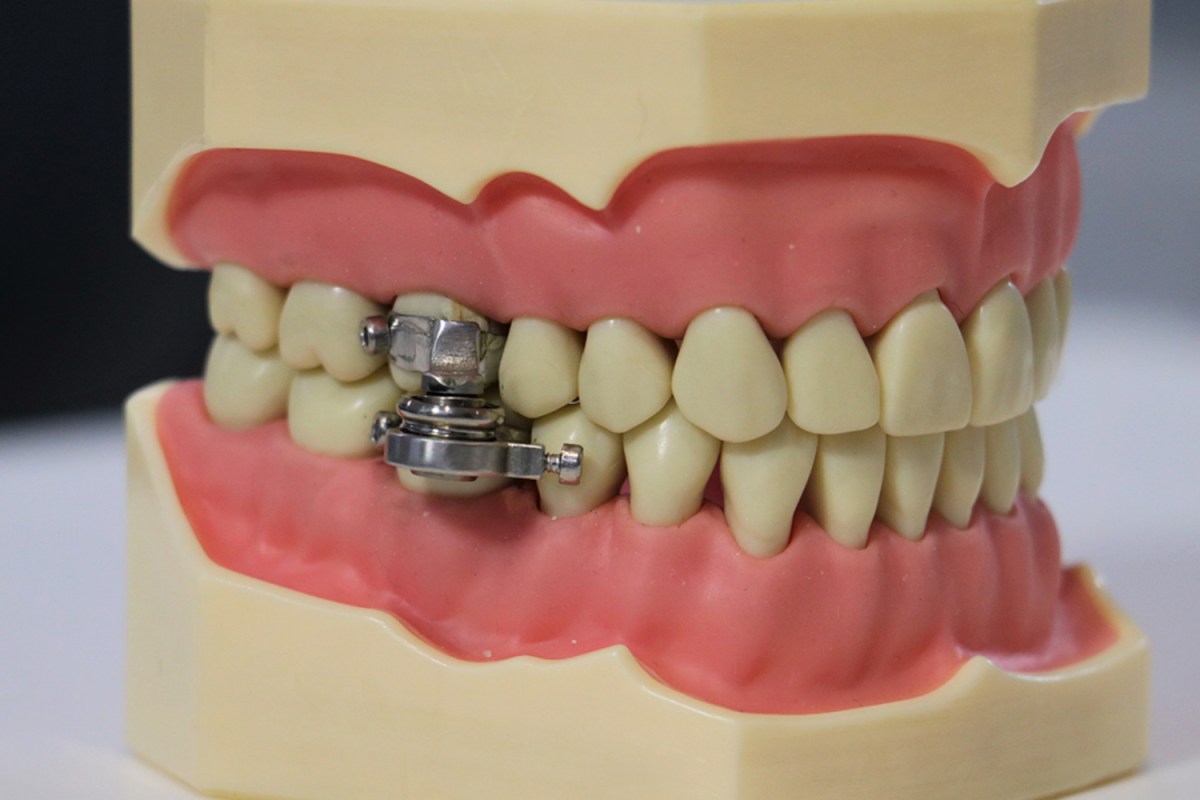 The DentalSlim Diet Control is a weight loss device that works by magnetically locking a wearer's jaw shut, preventing them from opening their mouth more than a few millimeters. Image shows the device modeled on a model jaw.
