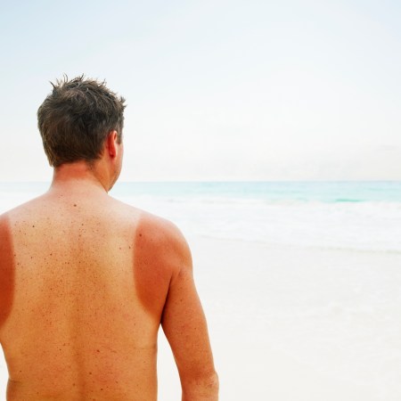 Man with sun burn standing near water on tropical beach rear view