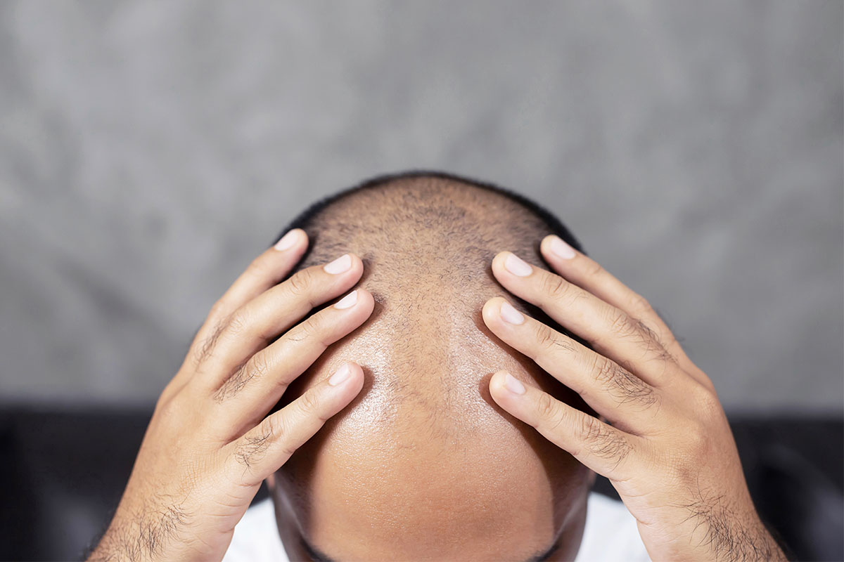 A man showing his bald head. New drugs are showing promise in treating hair loss related to alopecia areata.
