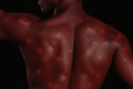 Closeup image of a man's back shows red skin and bumps; abstract concept of monkeypox