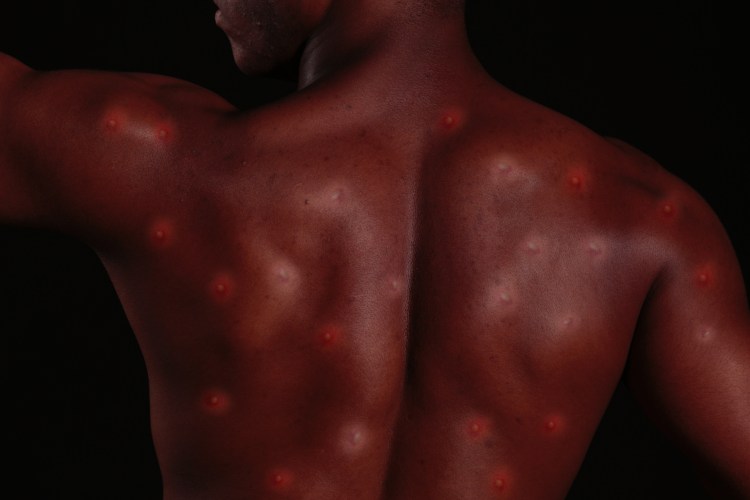 Closeup image of a man's back shows red skin and bumps; abstract concept of monkeypox