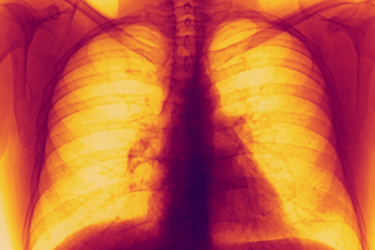 A New Pill Could Halve the Risk of Dying From Lung Cancer InsideHook