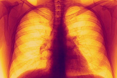 Lung X-rays
