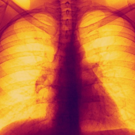 Lung X-rays