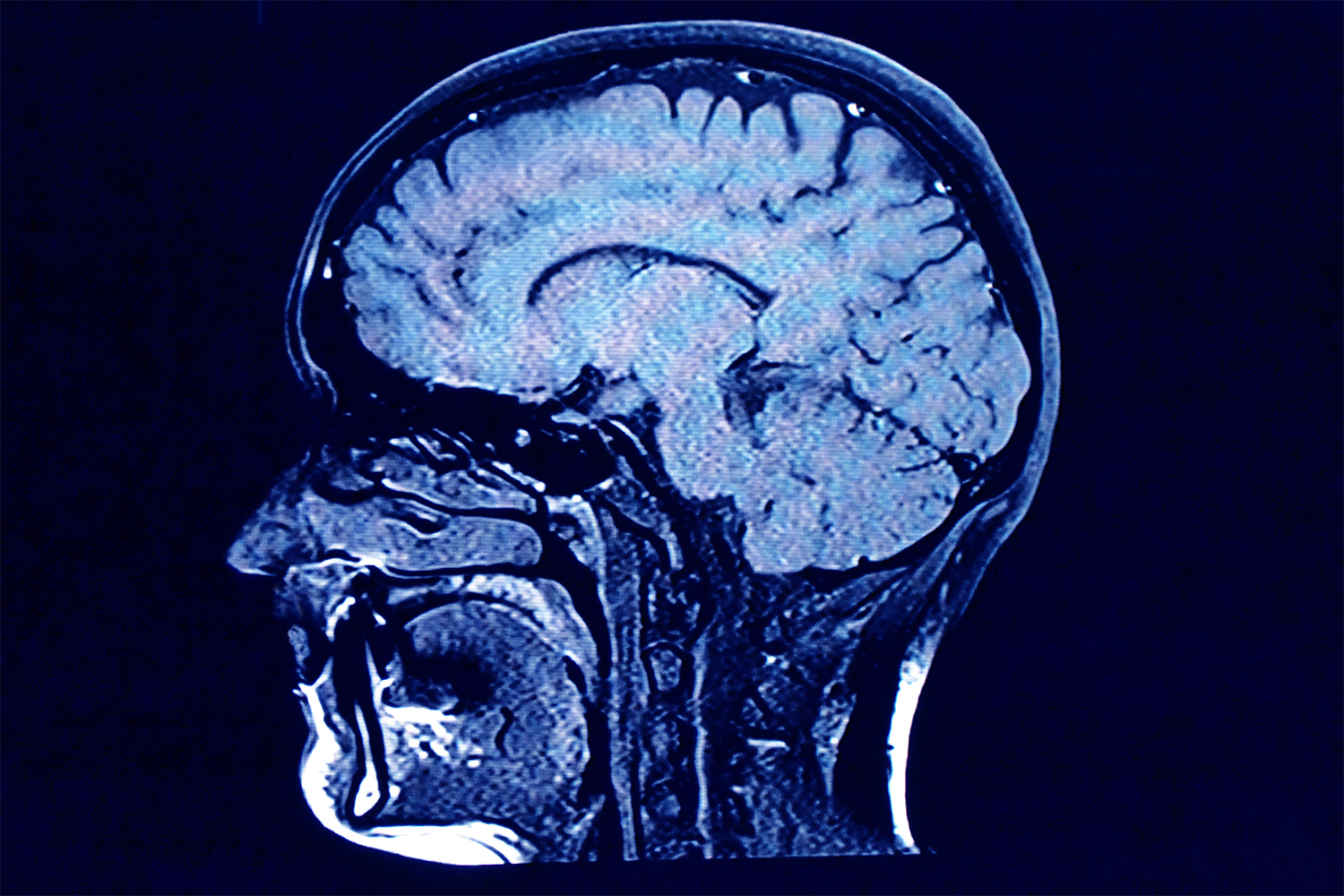 MRI scan showing brain activity. We take a look at the benefits creatine has on brain health.