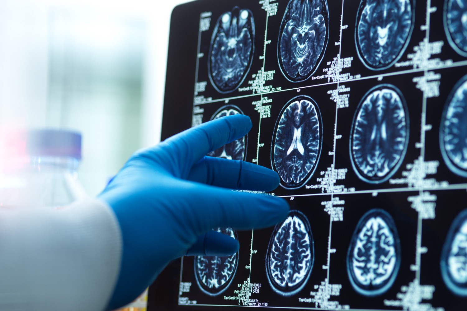 Doctor looking at brain scan