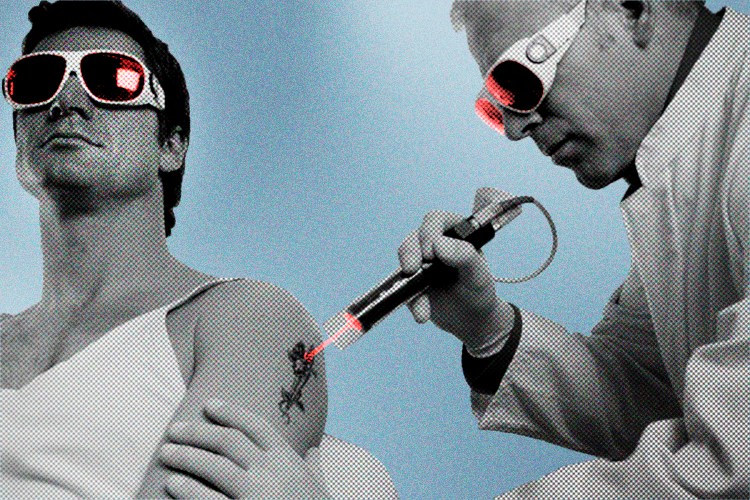 Person getting tattoo removed