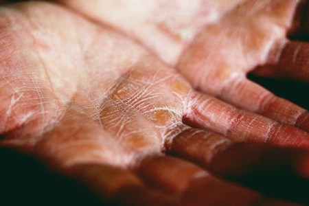 Hands with dry skin on palms