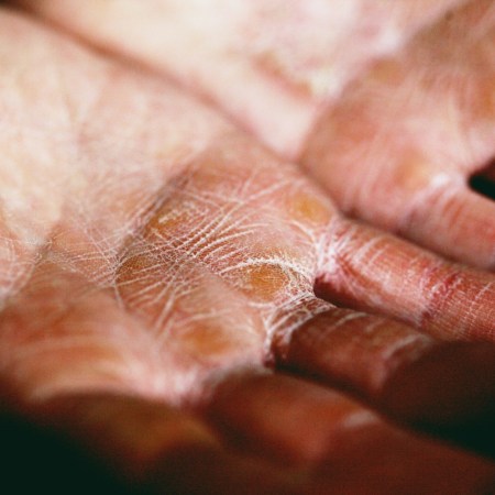 Hands with dry skin on palms
